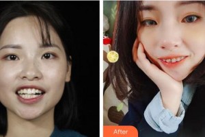 江陰東方女子醫(yī)院整形美容中心袁宇剛整形價(jià)格表附金屬托槽矯正案例展示