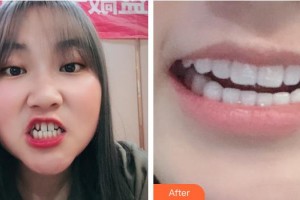 江陰艾爾美醫(yī)療美容診所安衛(wèi)平整形價(jià)格表附牙貼面案例展示