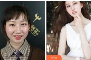 江陰光明眼科醫(yī)院朱建剛整形價(jià)格表附牙齒隱形矯正案例展示