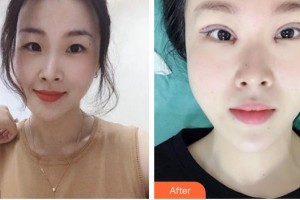 江陰艾爾美醫(yī)療美容診所井建民整形價(jià)格表附眼部綜合案例展示