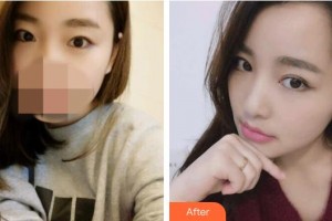 江陰市人民醫(yī)院整形美容科陳一松整形價(jià)格表附切開(kāi)雙眼皮案例展示