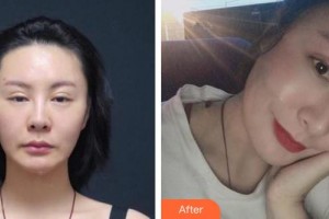 江陰艾爾美醫(yī)療美容診所元琦晸整形價(jià)格表附眼部修復(fù)案例展示