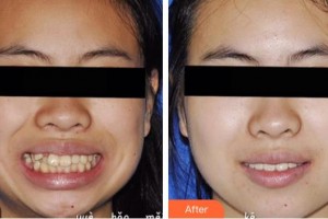 江陰牙博士口腔門(mén)診部李乃晨整形價(jià)格表附隱形托槽矯正案例展示