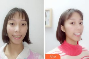 江陰牙博士口腔門(mén)診部關(guān)鑫整形價(jià)格表附超聲波潔牙案例展示