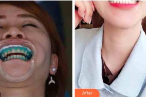 江陰金誠口腔門診部張杰整形價(jià)格表附冷光美白案例展示