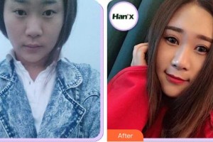 江陰光明眼科醫(yī)院鄒俊整形價(jià)格表附切開雙眼皮案例展示