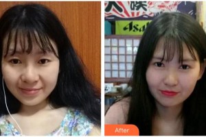 海南眼科醫(yī)院陳海波整形價(jià)格表附切開(kāi)雙眼皮案例展示