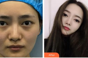 海南眼科醫(yī)院張秀蘭整形價(jià)格表附眼部修復(fù)案例展示