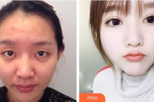 海南眼科醫(yī)院鐘興武整形價(jià)格表附眼部綜合案例展示