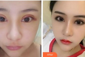 海南眼科醫(yī)院劉奕志整形價(jià)格表附切開(kāi)雙眼皮案例展示