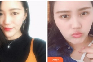 海南眼科醫(yī)院陳王靈整形價(jià)格表附眼部綜合案例展示