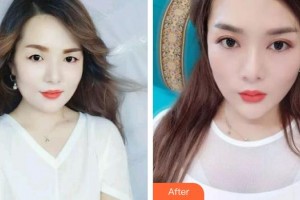 海南眼科醫(yī)院徐力整形價(jià)格表附眼部綜合案例展示