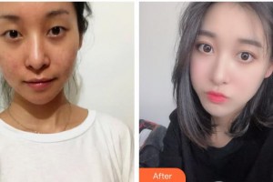 海南眼視光學(xué)中心門(mén)診部李加青整形價(jià)格表附開(kāi)內(nèi)眼角案例展示