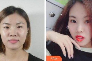 海南眼視光學(xué)中心門(mén)診部劉春民整形價(jià)格表附切開(kāi)雙眼皮案例展示