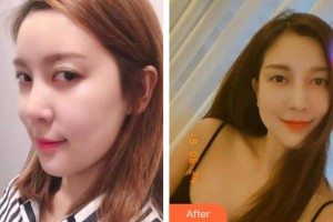 海南眼科醫(yī)院冼文光整形價(jià)格表附眼部修復(fù)案例展示