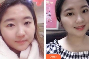 海南省中醫(yī)院眼科中心任韓整形價(jià)格表附切開(kāi)雙眼皮案例展示