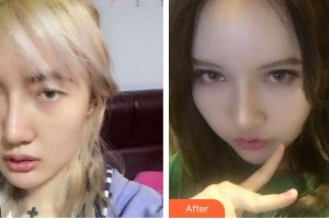 海南省中醫(yī)院眼科中心廖繼波整形價(jià)格表附切開(kāi)雙眼皮案例展示