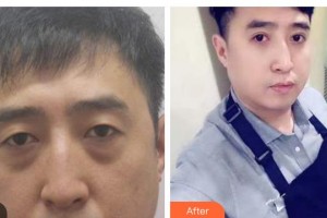 海南省中醫(yī)院眼科中心陳得謎住院醫(yī)師整形價(jià)格表附切開(kāi)雙眼皮案例展示