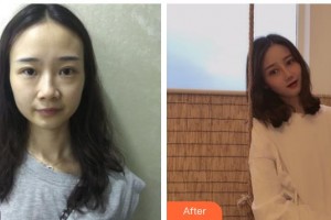 海南眼視光學(xué)中心門(mén)診部梁瓊整形價(jià)格表附切開(kāi)雙眼皮案例展示