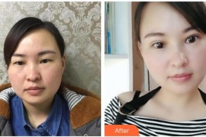 海南眼科醫(yī)院史貽玉整形價(jià)格表附切開(kāi)雙眼皮案例展示