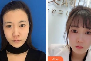 ?？跂|湖醫(yī)學美容整形醫(yī)院張文其整形價格表附去痘印痘坑案例展示