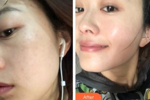 海口鵬愛醫(yī)療美容醫(yī)院任秀麗整形價格表附激光祛斑案例展示