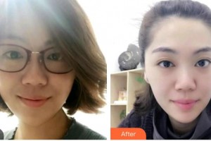 ?？诖揸匚尼t(yī)療美容診所崔曦文整形價格表附光子嫩膚案例展示