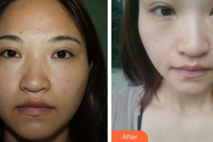 ?？谑械谒娜嗣襻t(yī)院眼科鐘羽麗整形價格表附清潔祛痘案例展示