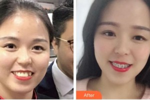 ?？诤佳谰S信口腔門診部李娜住院醫(yī)師整形價格表附自鎖托槽矯正案例展示