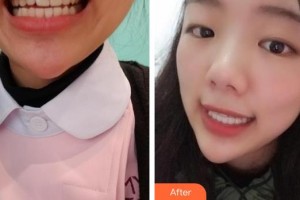 海口杭牙維信口腔門診部樸光裕整形價格表附隱形托槽矯正案例展示