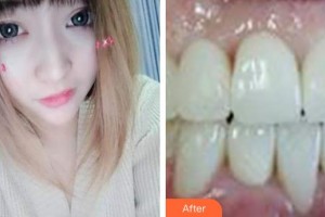 海口德恩口腔門診部喬磊整形價格表附超聲波潔牙案例展示