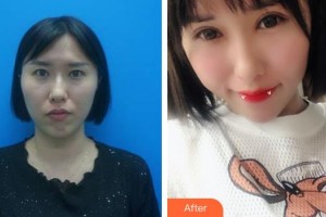 ?？诩t妝尚醫(yī)療美容門診部羅勇整形價格表附內(nèi)切祛眼袋案例展示