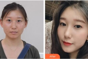 ?？诩t妝尚醫(yī)療美容門診部袁兆周整形價格表附切開雙眼皮案例展示