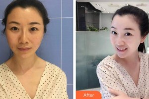 海口紅妝尚醫(yī)療美容門診部李楠整形價格表附埋線提升案例展示