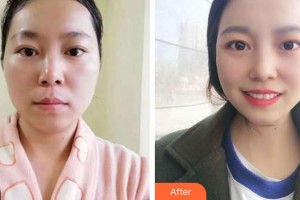 揚州施爾美醫(yī)療美容醫(yī)院厲建華整形價格表附激光祛斑案例展示