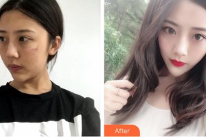 揚州第一人民醫(yī)院整形美容科雷岳崇整形價格表附微創(chuàng)疤痕修復(fù)案例展示