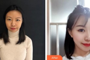 揚(yáng)州第一人民醫(yī)院整形美容科馮有支整形價(jià)格表附去痘印痘坑案例展示