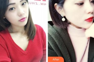 揚州第一人民醫(yī)院整形美容科陳菊萍整形價格表附無針?biāo)獍咐故?>
</a>
<h3 class=