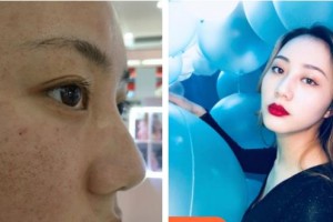 揚(yáng)州施爾美醫(yī)療美容醫(yī)院王釗整形價(jià)格表附去痘印痘坑案例展示