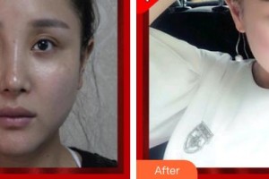 揚(yáng)州第一人民醫(yī)院整形美容科夏卉整形價(jià)格表附清潔祛痘案例展示