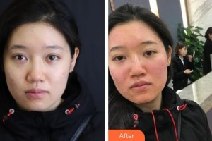 揚(yáng)州施爾美醫(yī)療美容醫(yī)院代淑媛整形價(jià)格表附祛斑祛痣案例展示