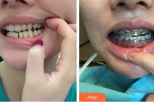 揚(yáng)州麗致醫(yī)療美容門診部湯春波整形價(jià)格表附金屬托槽矯正案例展示