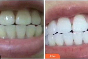 揚(yáng)州艾菲斯醫(yī)療美容門診部王愛梅整形價(jià)格表附美白貼片案例展示