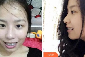 揚州貝恩口腔醫(yī)院曾小法整形價格表附金屬托槽矯正案例展示