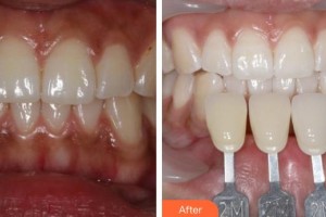 揚州黃嬋醫(yī)療美容診所黃嬋整形價格表附冷光美白案例展示