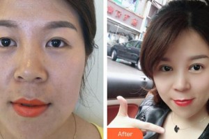 荊州愛爾眼科醫(yī)院胡淑瓊整形價格表附埋線雙眼皮案例展示