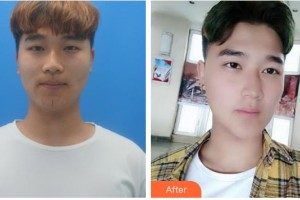 荊州市婦幼保健院眼科杜東成整形價格表附切開雙眼皮案例展示