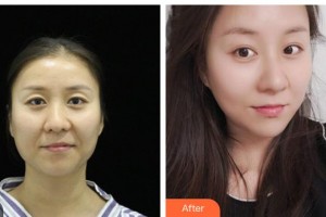 荊州市婦幼保健院眼科何維銘整形價格表附眼部修復案例展示