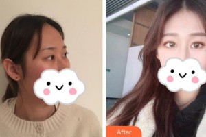 荊州市婦幼保健院眼科張進整形價格表附眼部綜合案例展示