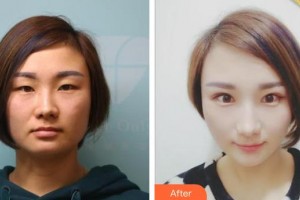 荊州市婦幼保健院眼科王百祥整形價格表附埋線雙眼皮案例展示